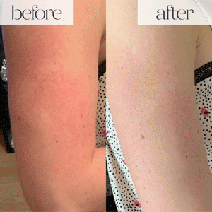 Ipl hair lesser removal